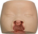Bilateral cleft lip