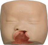 Left clift lip