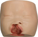 Right clift lip